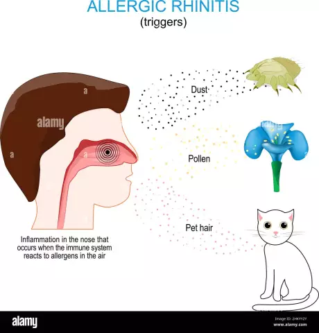 Allergische Rhinitis: Symptome, Behandlung Und Hausmittel