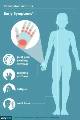 Bilder Von Symptomen Der Psoriasis-Arthritis