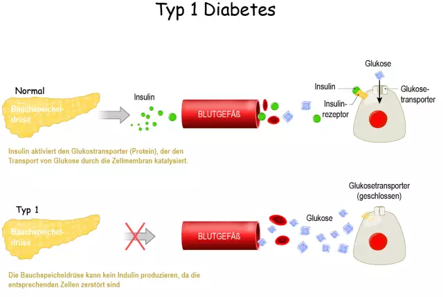 Diabetes Und Desserts: Was Sie Wissen Müssen