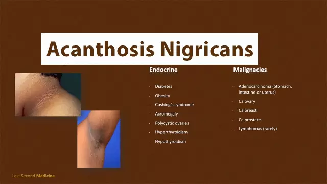 Acanthosis Nigricans: Behandling, Bilder Och Orsaker