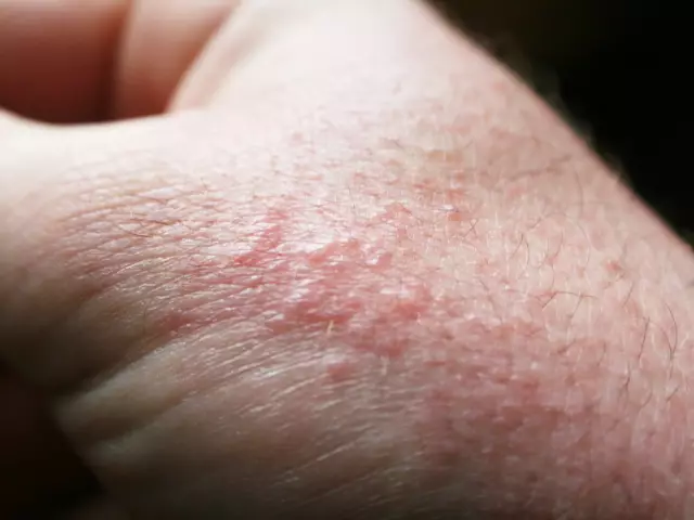 Poison Oak Rash: Bilder Und Heilmittel