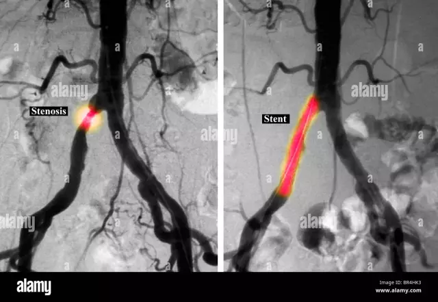 Perifera Artärangioplastik Och Stentplacering