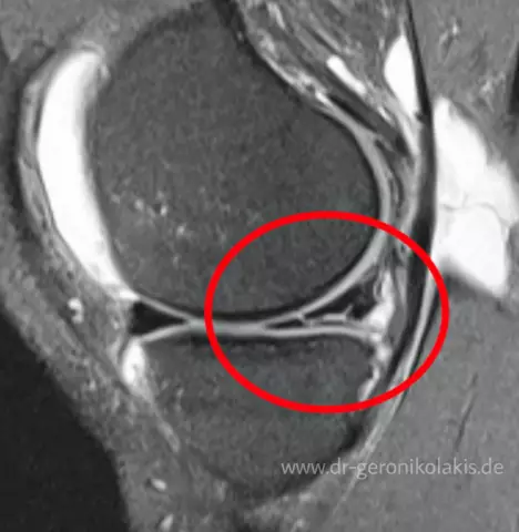 Meniskusriss Des Knies: Ursachen, Symptome Und Diagnose
