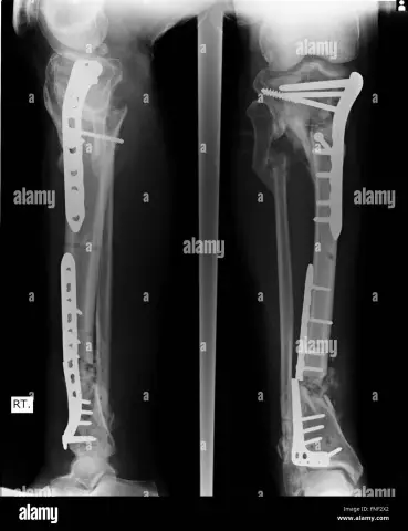 Ellenbogenschmerzen: Typen, Diagnose Und Behandlungen