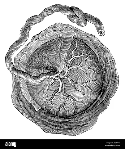 Niedrig Liegende Plazenta (Placenta Previa)