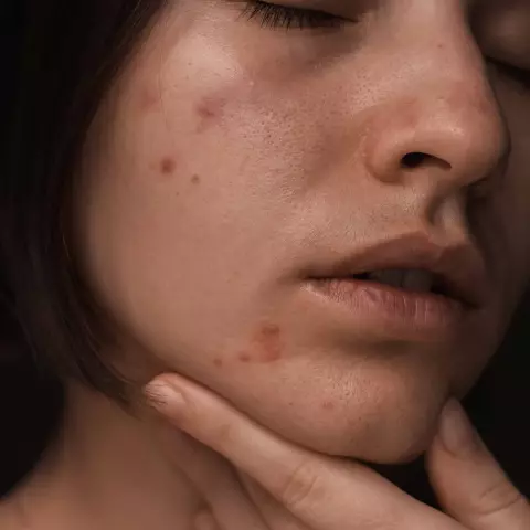 Dermatitis: Ursachen, Arten Und Behandlungen