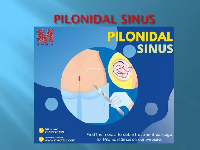 Pilonidal Sinus: Ursachen, Symptome Und Behandlungen