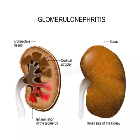 Glomerulonephritis: Ursachen, Symptome Und Behandlung