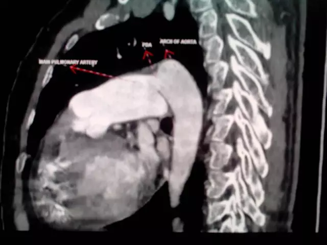 Patent Ductus Arteriosus: Ursachen, Symptome Und Diagnose