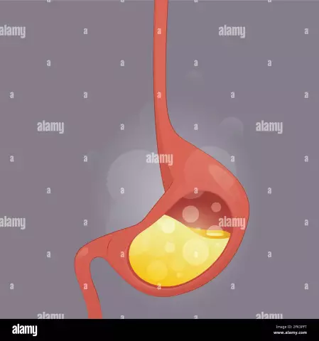 Halsschmerzen Und Saurer Reflux