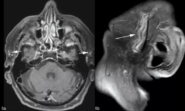 Temporale Arteriitis: Symptome, Diagnose Und Behandlung