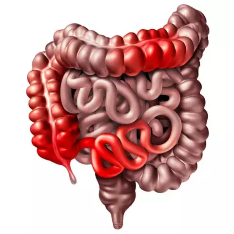 10 Wichtige Fragen, Die Sie Ihrem Arzt Zu Morbus Crohn Stellen Sollten